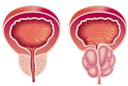 Symptômes de la prostatite chez les hommes